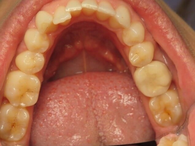 Before and After Composite Fillings & Invisalign® Orthodontics & Laser