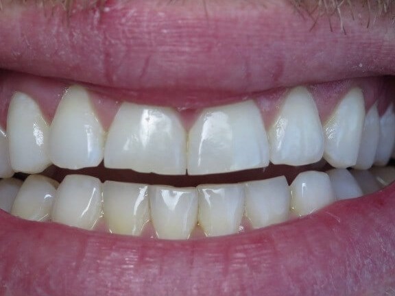 Laser teeth whitening dallas