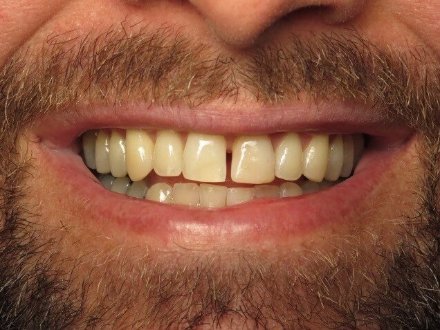 Davinci laser teeth whitening reviews