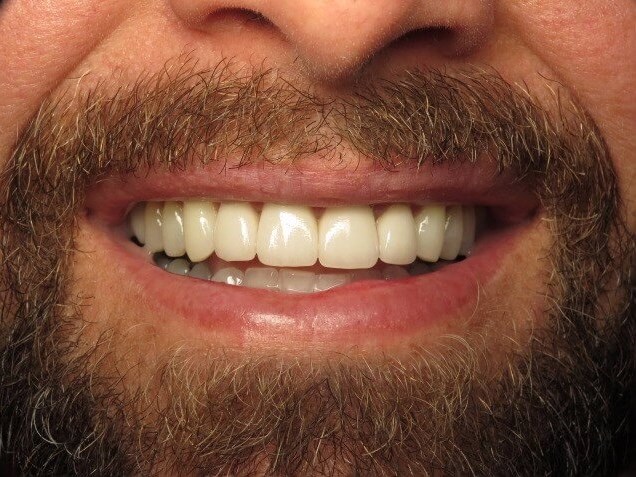 Davinci laser teeth whitening reviews