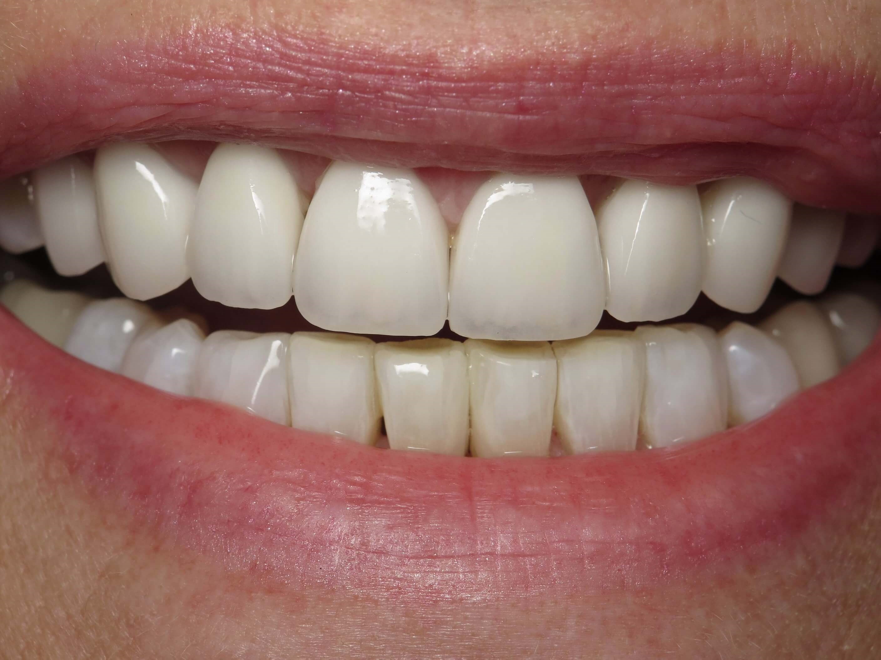Before and After da Vinci™ Porcelain Veneers & Composite Fillings & Dental Veneers & Laser Gum ...