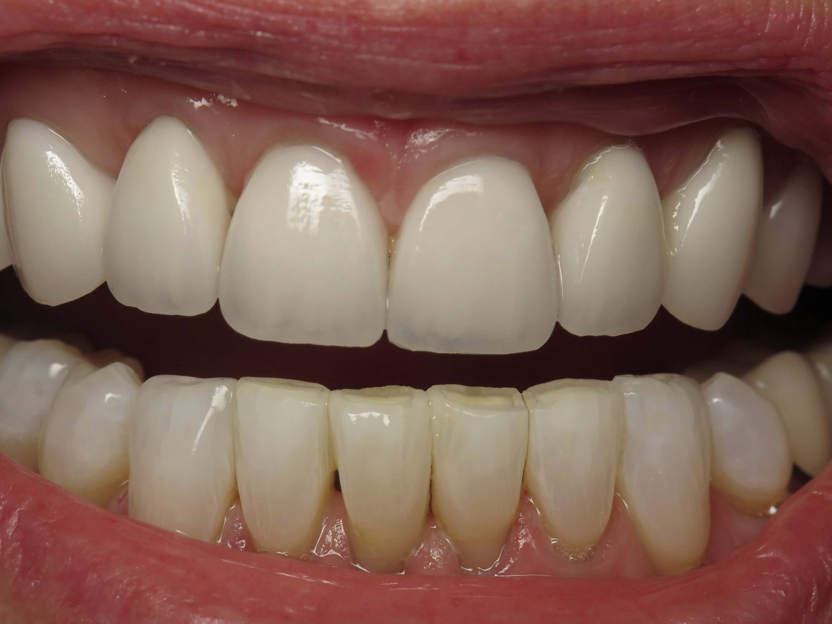 Laser teeth whitening images