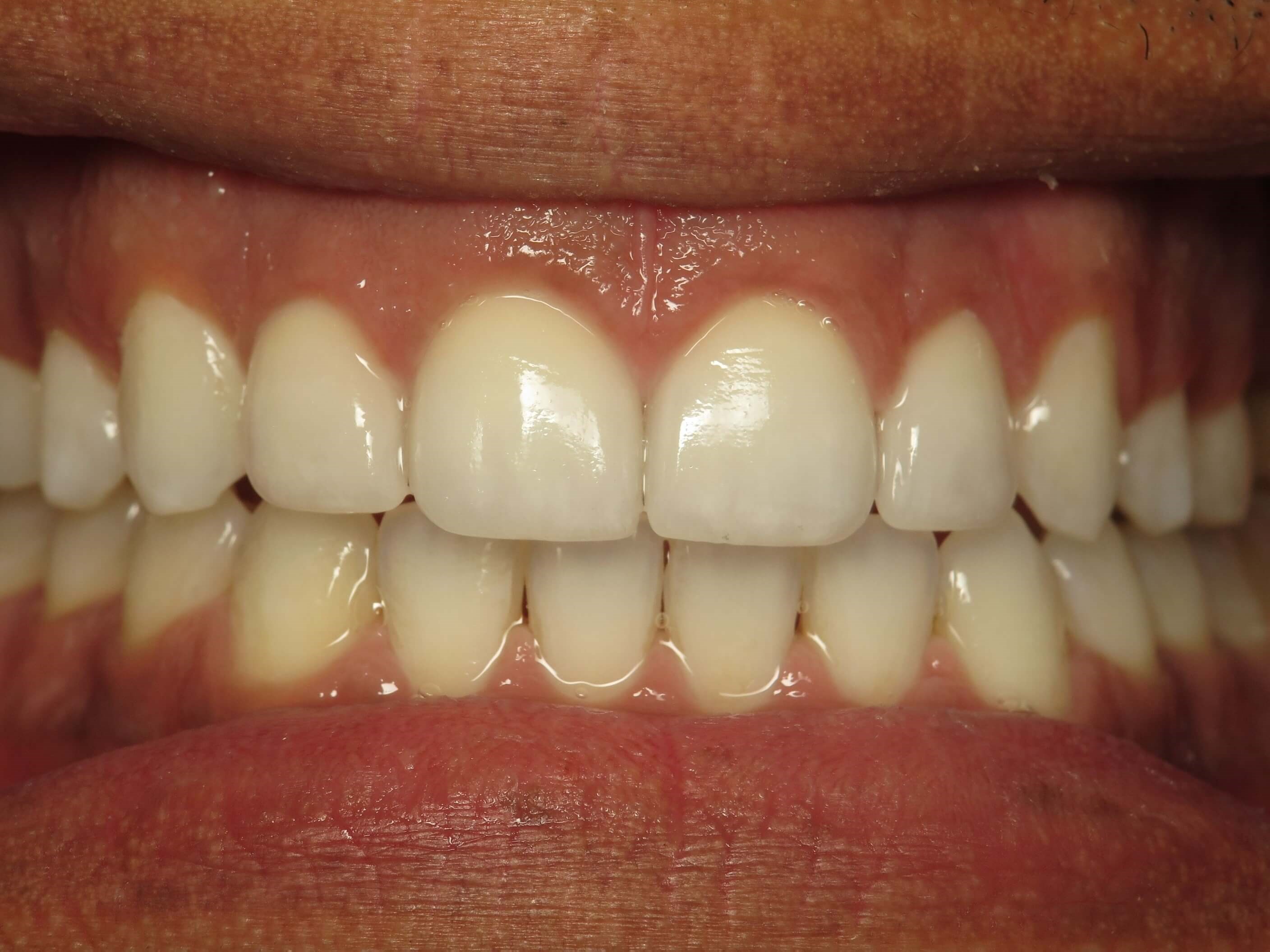 Before and After Invisalign® Orthodontics & Teeth Whitening & Dallas