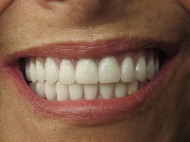 Before and After All On 4 Dental Implants & Free Smile Consultation