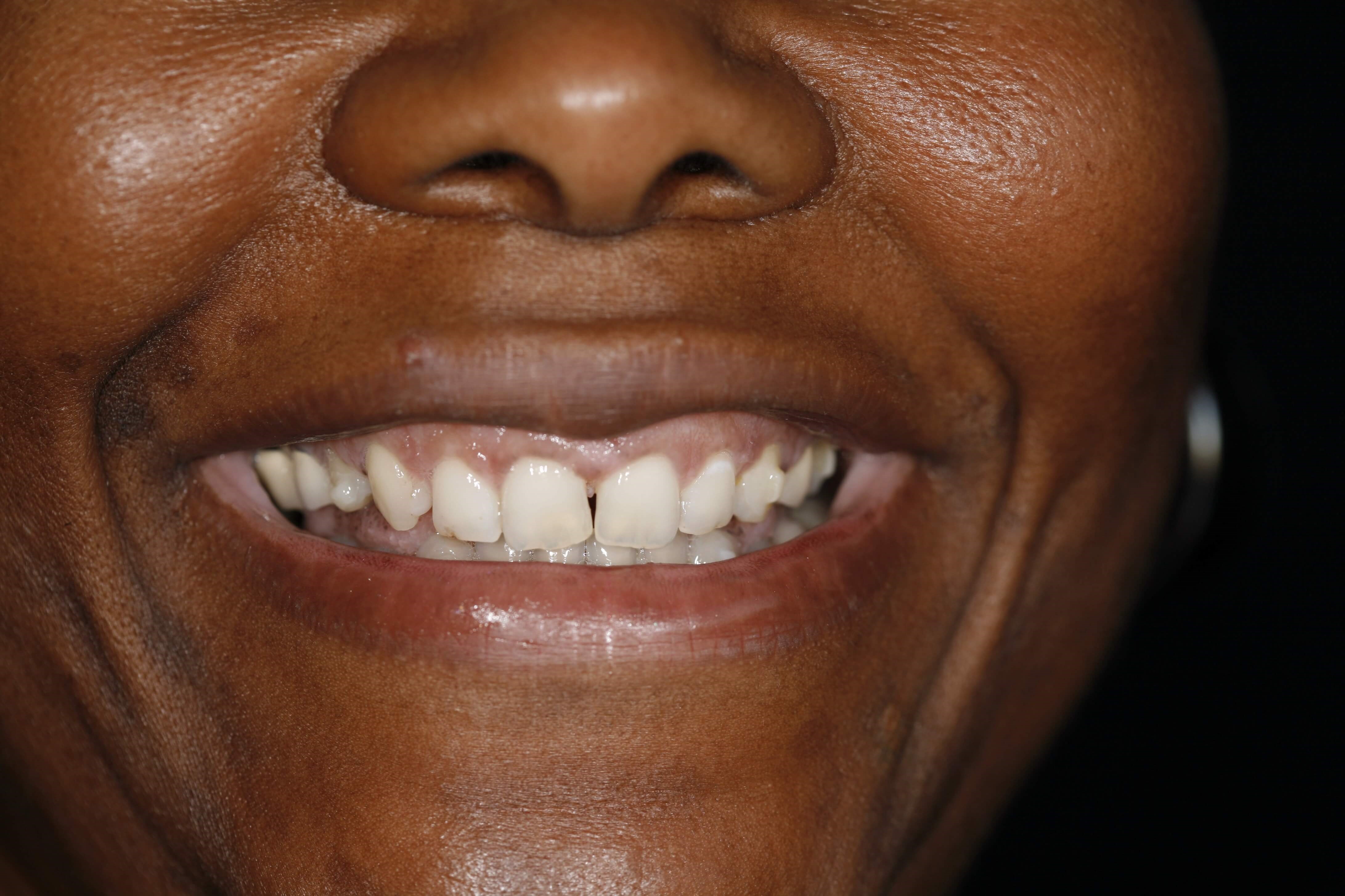 Invisalign Express