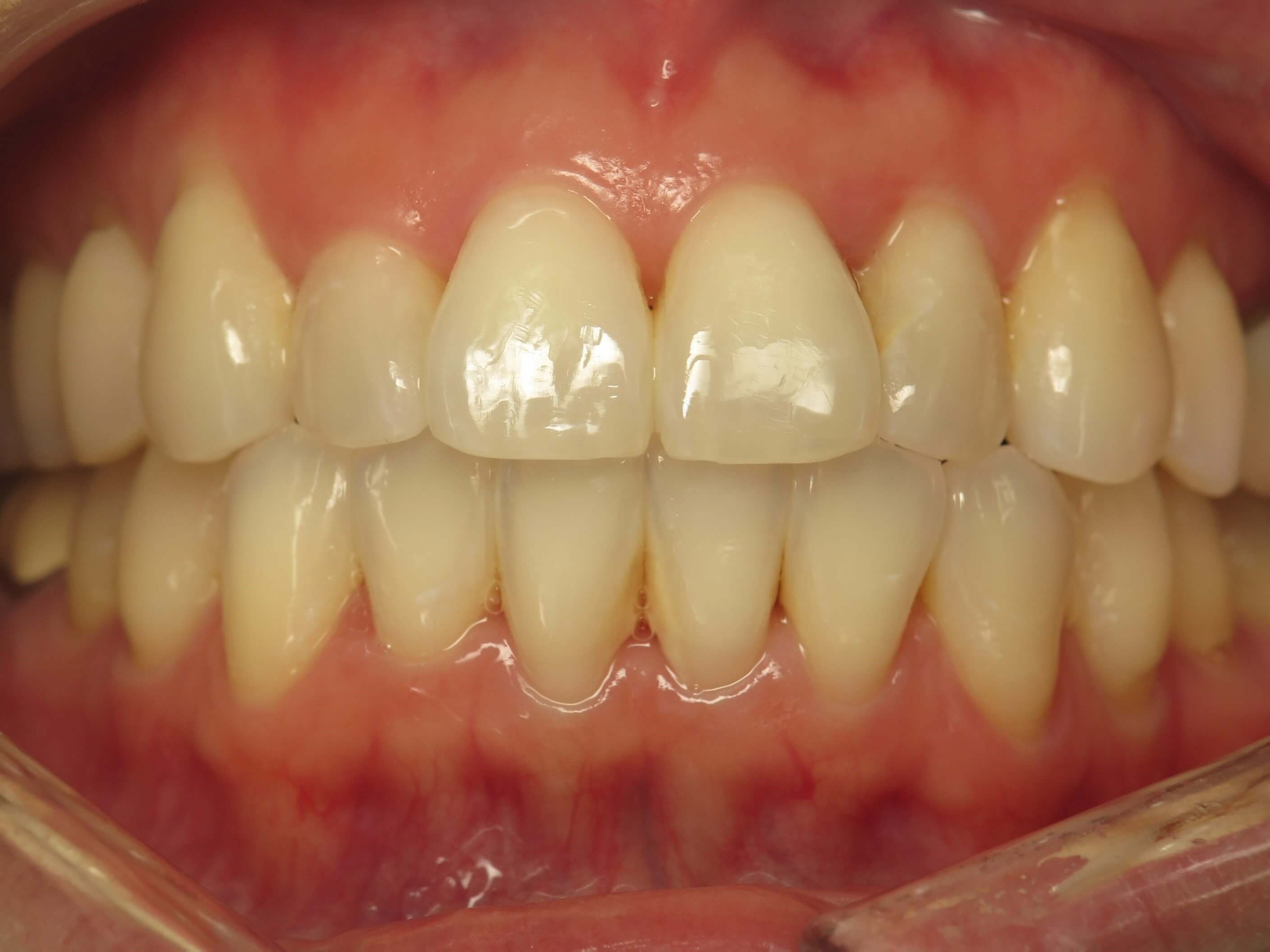 Before and After Laser Teeth Whitening & Teeth Whitening ...