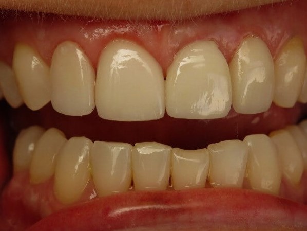 Before and After Dental Implants & Crowns & Laser Gum ... Before and After Dental Implants & Crowns & Laser Gum ...