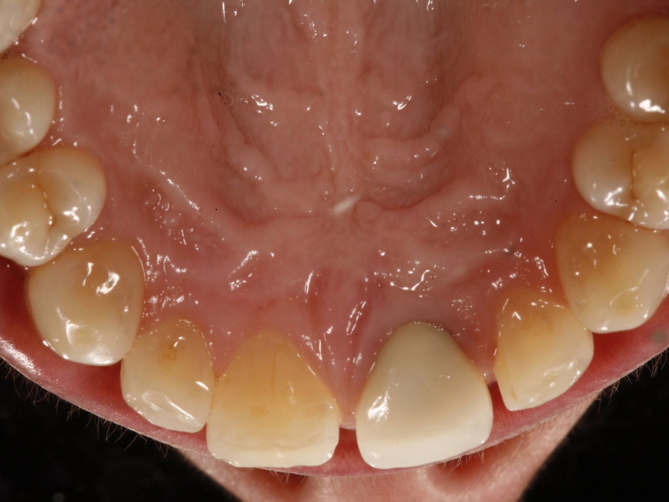Before and After Dental Implants & Crowns & Laser Gum ... Before and After Dental Implants & Crowns & Laser Gum ...