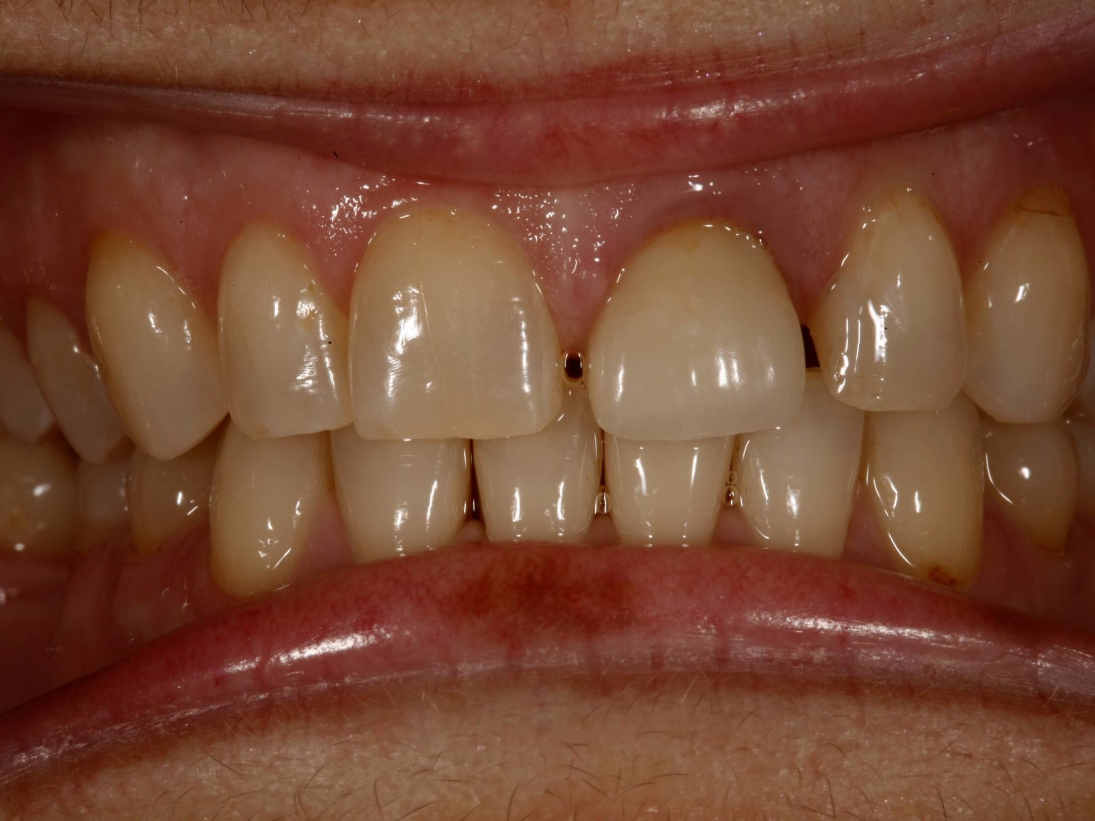 Before and After Dental Implants & Crowns & Laser Gum ... Before and After Dental Implants & Crowns & Laser Gum ...