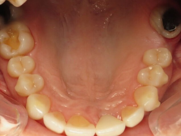 Before and After Dental Implants & Crowns & Laser Gum ... Before and After Dental Implants & Crowns & Laser Gum ...