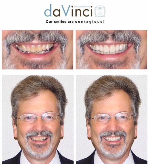 Smile Simulation