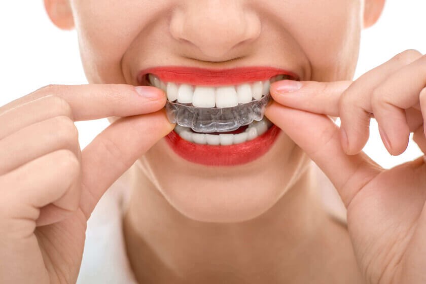 Invisalign Teeth Straightening