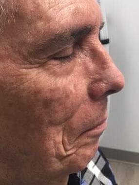 Before And After Mohs Surgery Squamous Cell Carcinoma Photos