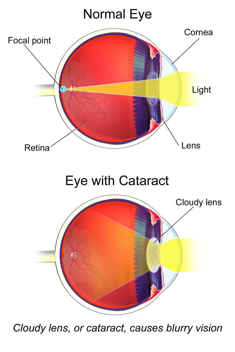 Everything You Need To Know About Cataract Surgery Everything You Need