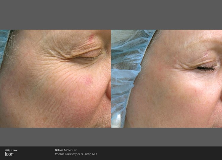 Before/After example 1