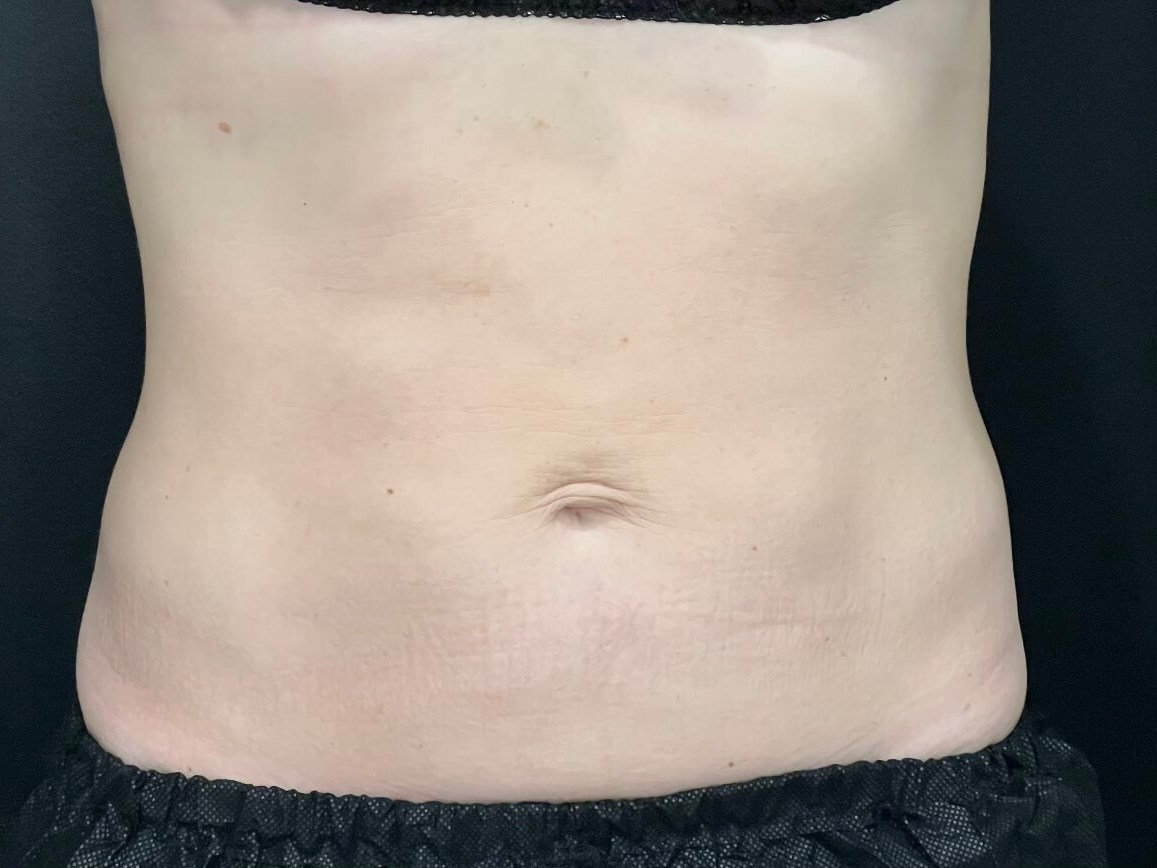 CoolSculpting Abdomen After
