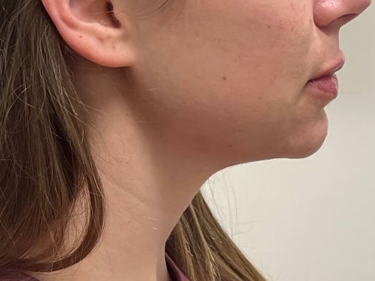 Restylane Chin Enhancement After