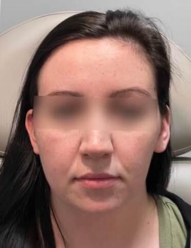 Juvederm Face Enhancement Before