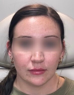 Juvederm Face Enhancement After