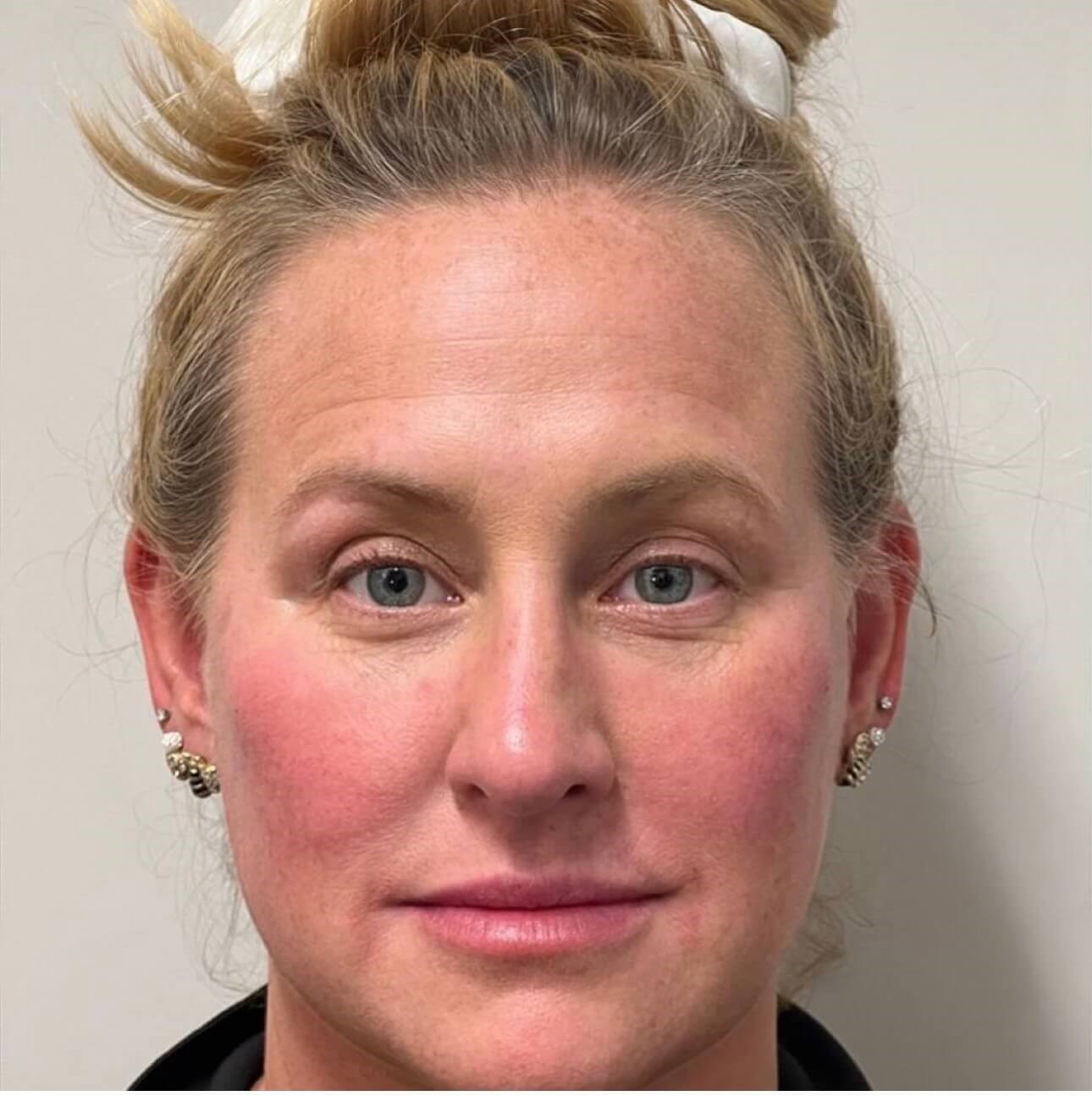 Juvederm Face Enhancement After