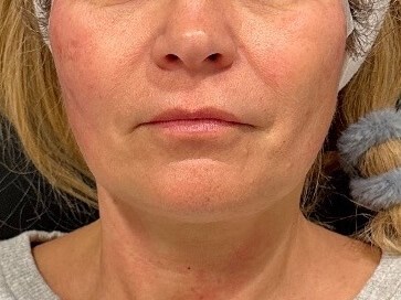 PDO Thread Lift After