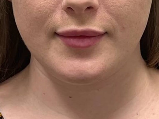 Massetter Botox After