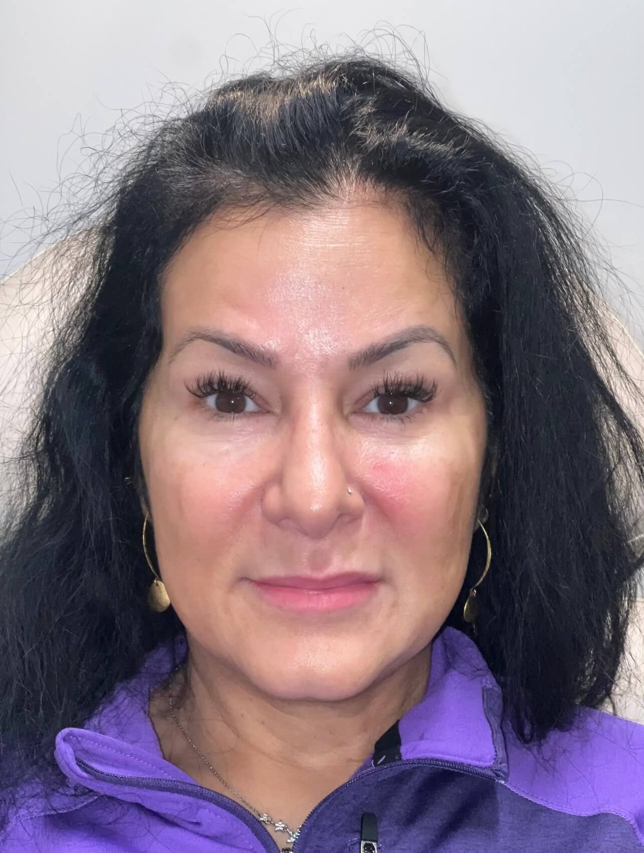Juvederm Jawline Volux Before