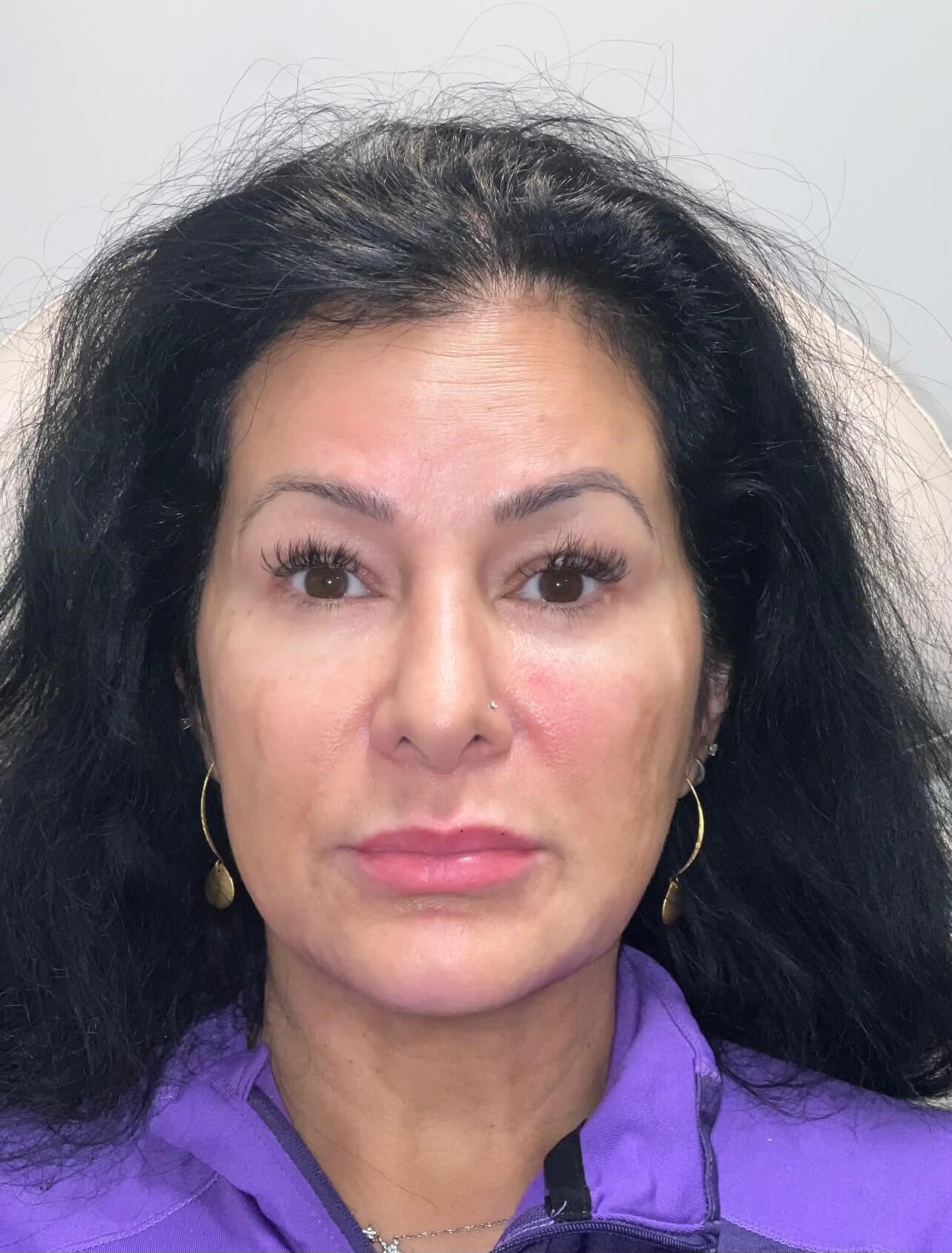 Juvederm Jawline Volux After