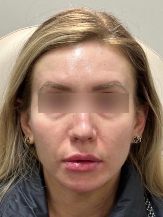 Juvederm Face Enhancement After
