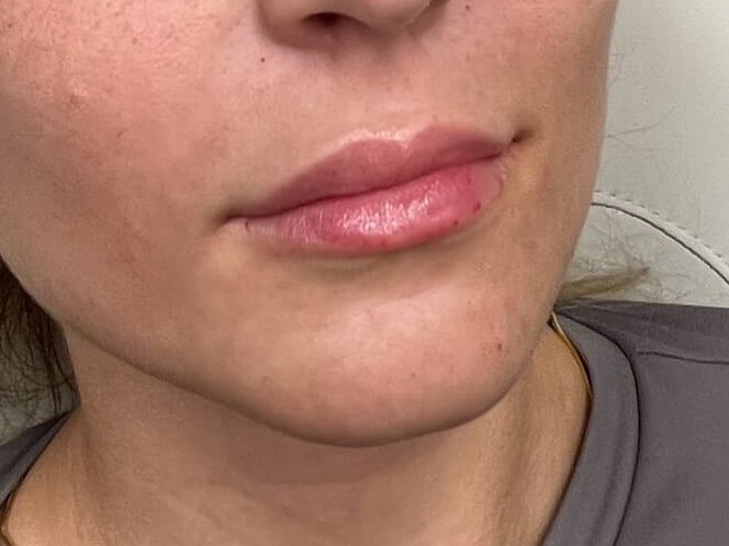 Juvederm Lip Enhancement After
