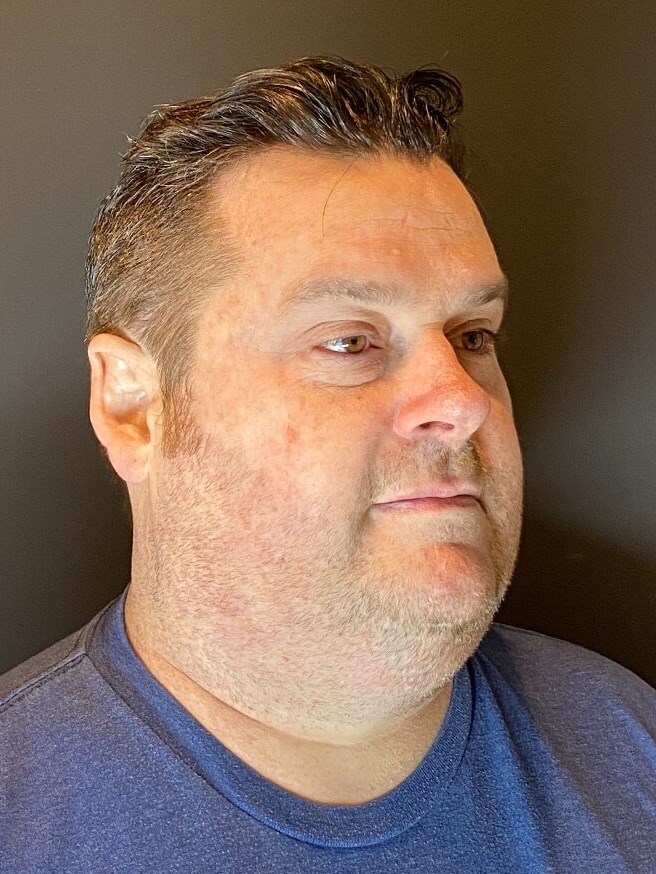 Cool Sculpting Chin Before
