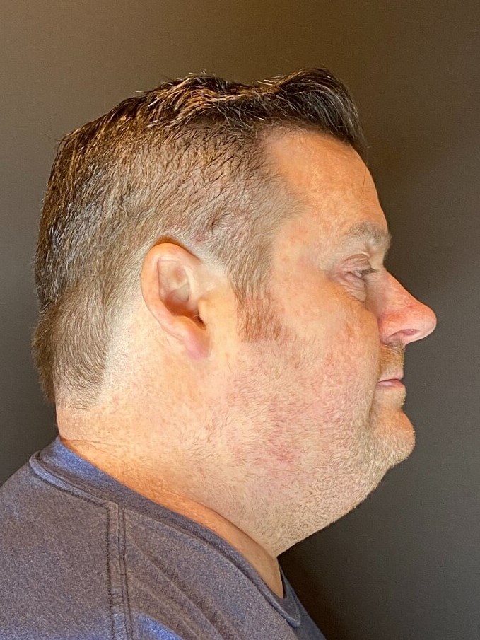 CoolSculpting  Chin Before