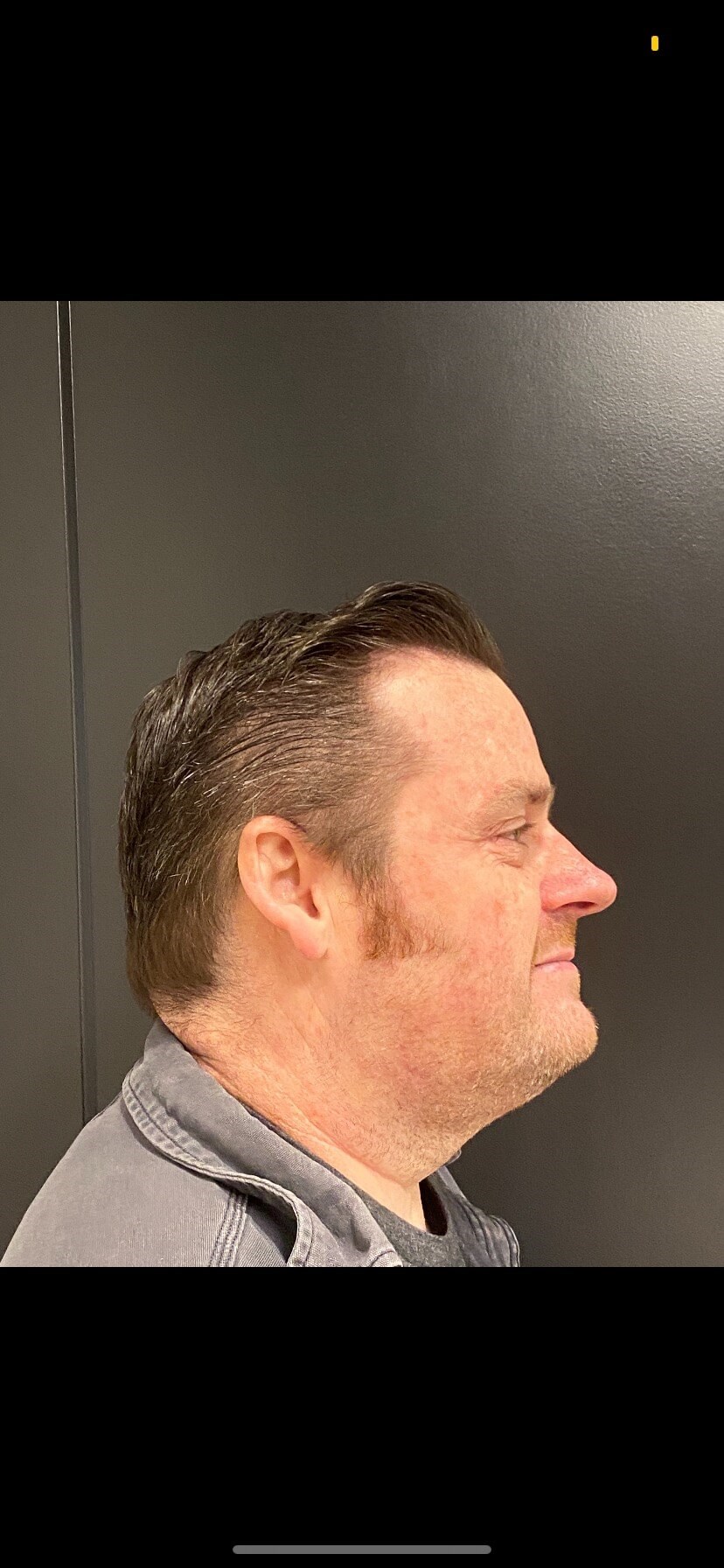 CoolSculpting  Chin After