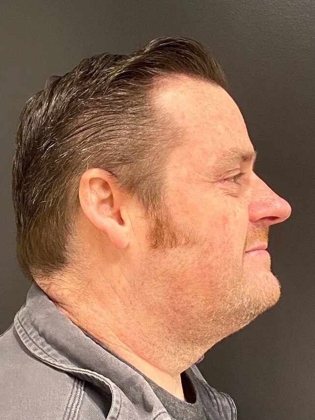 CoolSculpting  Chin After