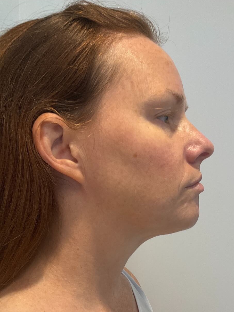 CoolSculpting  Chin After