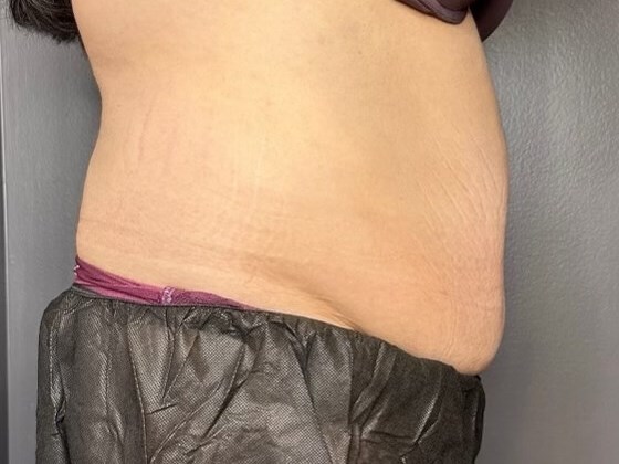 CoolSculpting Abdomen After
