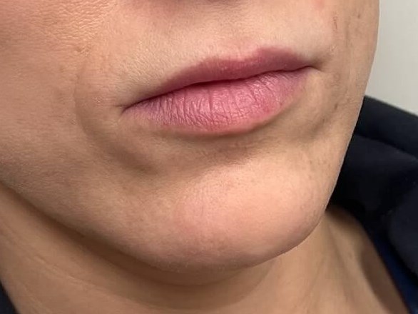 Juvederm Lip Enhancement Before