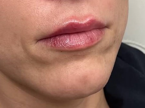 Juvederm Lip Enhancement After