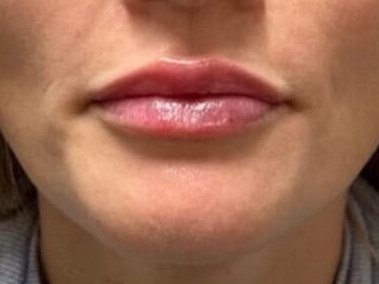 Juvederm Lip Enhancement After