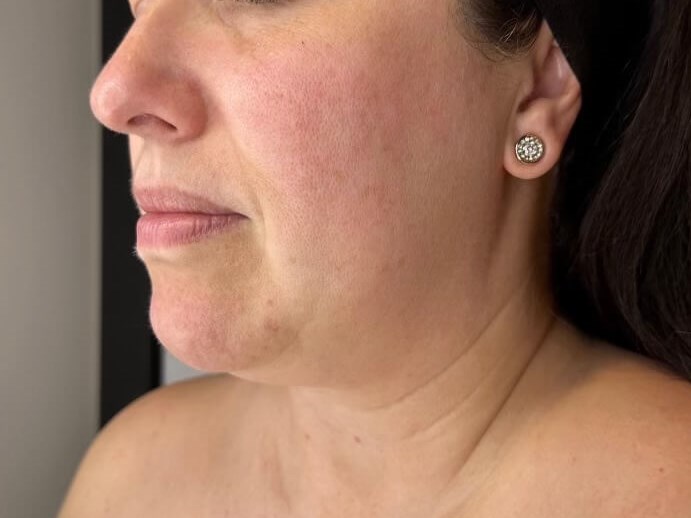 BBL Photo Facial After