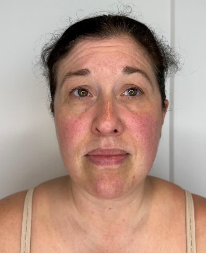 BBL Photo Facial Before