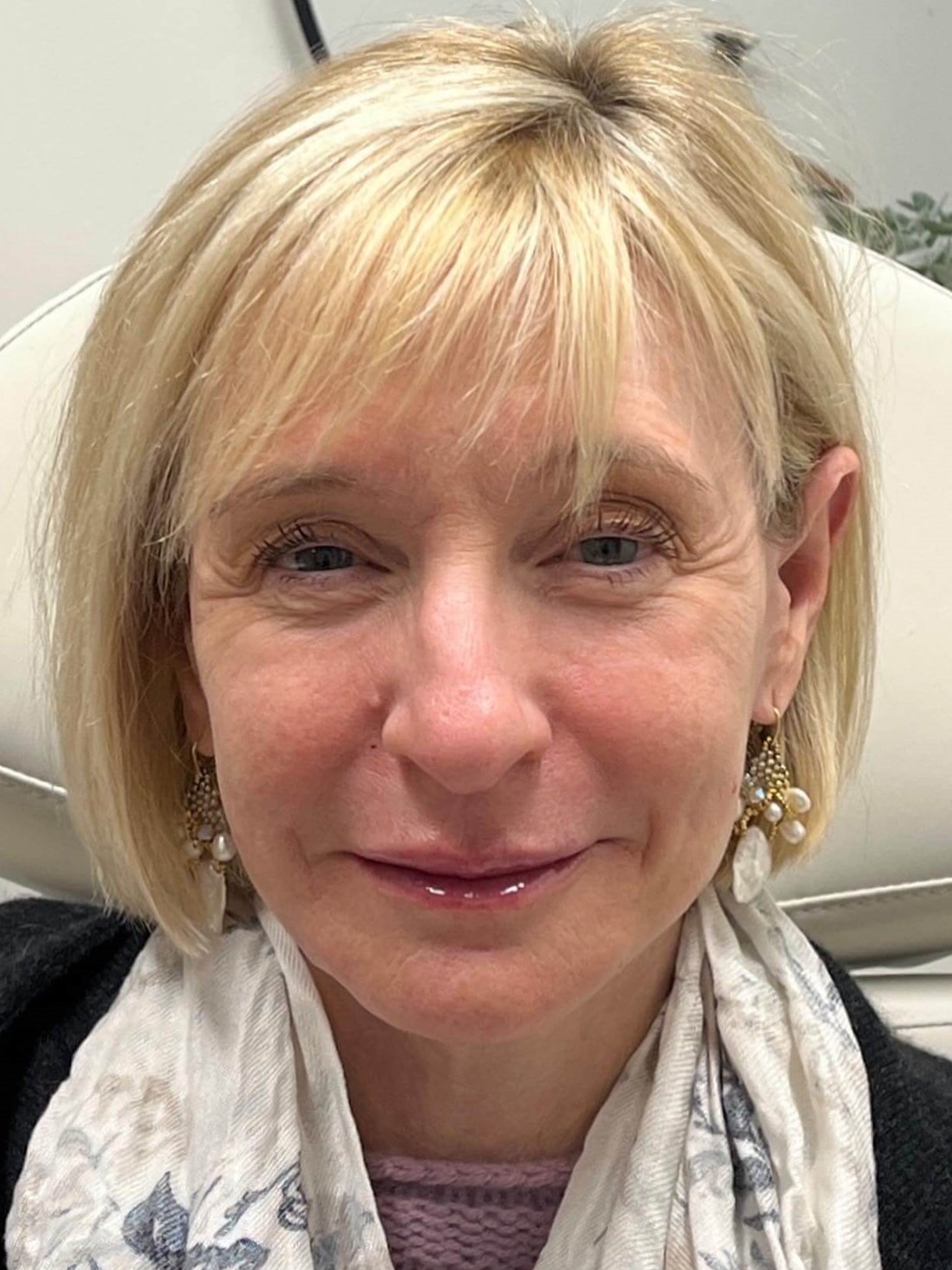 Sculptra Enhancement After