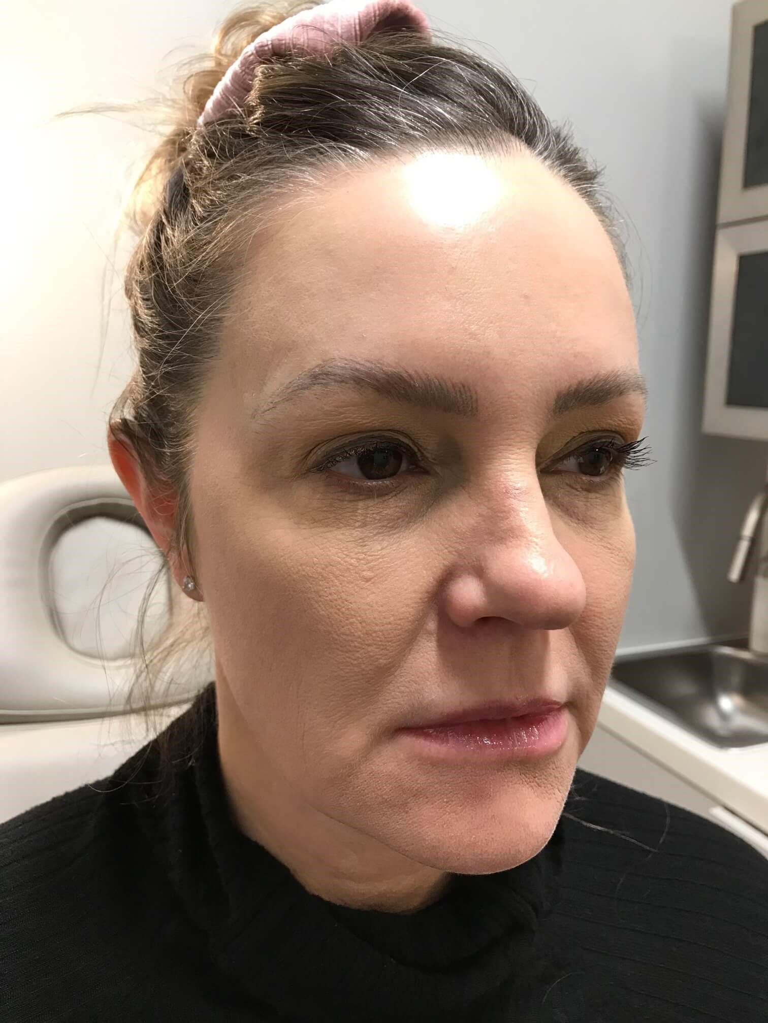 Juvederm Face Enhancement Before