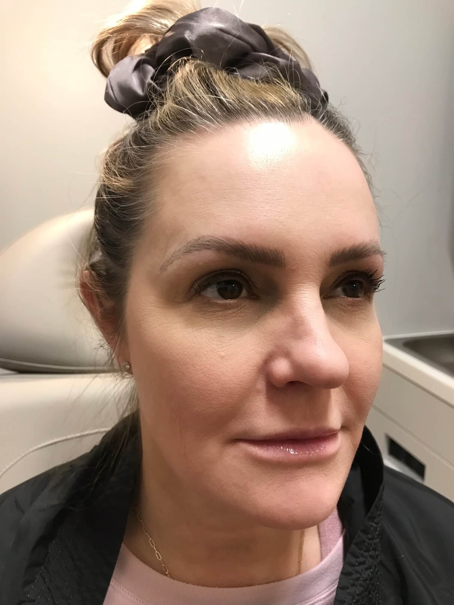 Juvederm Face Enhancement After