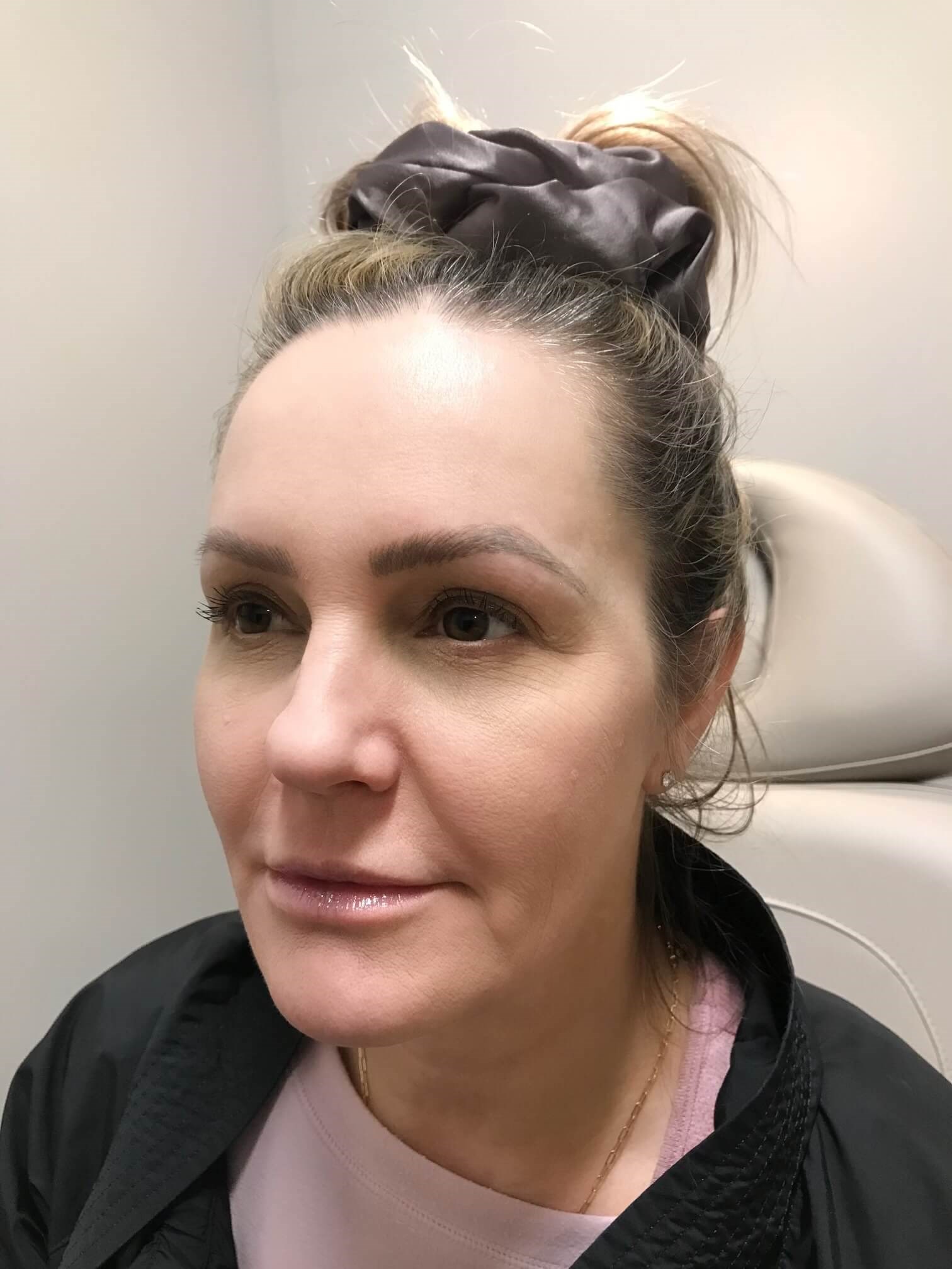 Juvederm Face Enhancement After