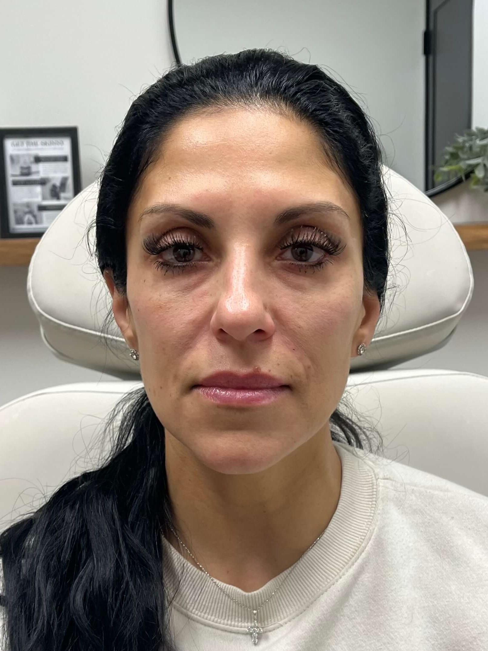 Juvederm Face Enhancement After