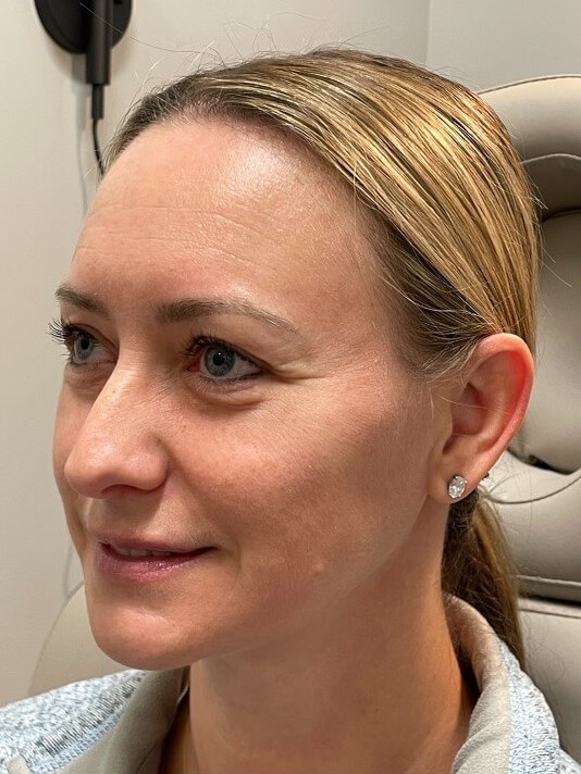 Juvederm Face Enhancement After