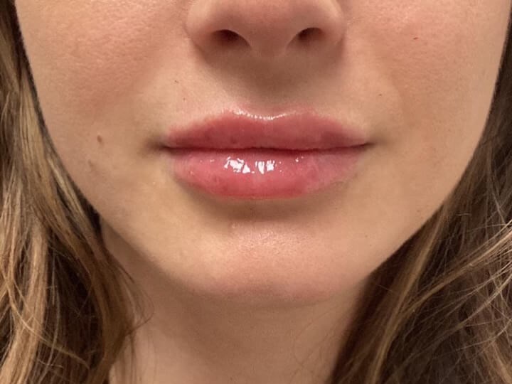 Juvederm Lip Enhancement After