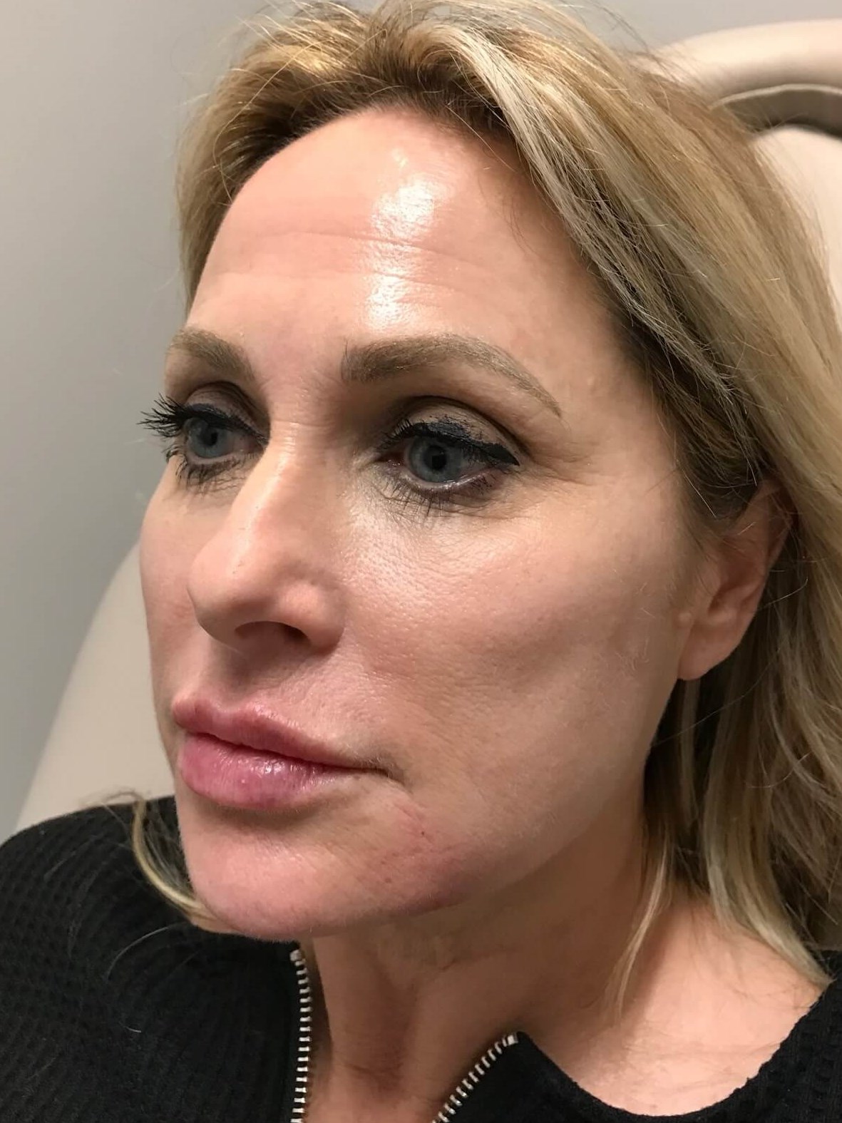 Juvederm Face Enhancement After