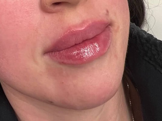 Juvederm Lip Enhancement After
